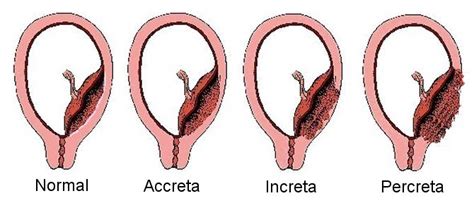 017 - Prof Yee Leung Obstetric and surgical management of abnormally invasive placenta ...