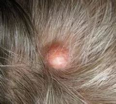 Atheroma - Treatment, Removal, Causes | Diseases 2024