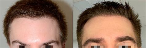 Eyebrow Hair Transplant photos | Miami, FL | Patient121673