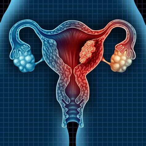 Endometrial and cervical cancer - Insights into Imaging