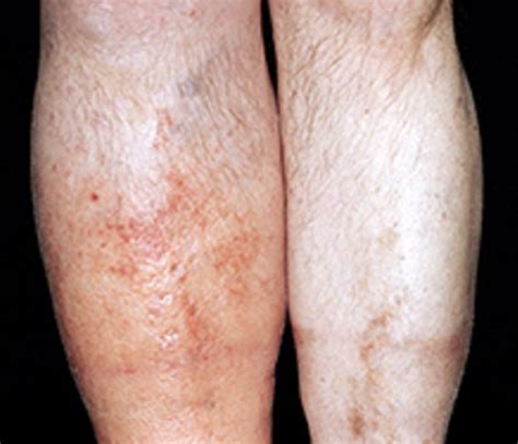 DEEP VEIN THROMBOSIS: SYMPTOMS, SIGNS, AND TREATMENT | Supreme Vascular and Interventional Clinic