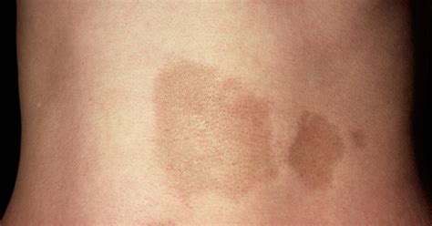 Morphea: Symptoms, Causes & Treatment | Types of Morphea