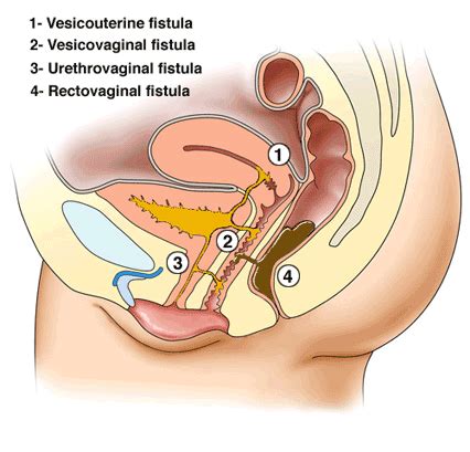 Understanding Vaginal Fistulas: Causes, Types, and Treatment Options