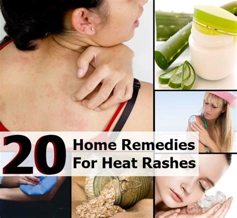 Heat rash, Home remedies and Remedies on Pinterest