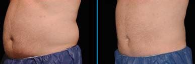 Men’s Coolsculpting – londonharleystreetclinics.com