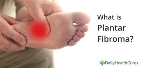 What is Plantar Fibroma and How is it Treated?