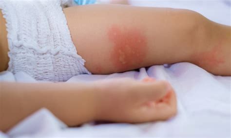 Is your child allergic to mosquitoes? Dr Sam Hay | The Advertiser