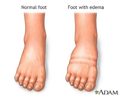 Foot Edema