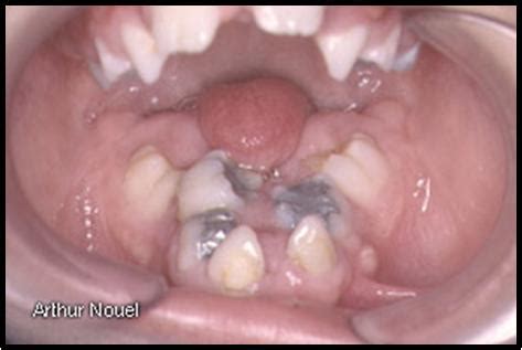 Dentistry lectures for MFDS/MJDF/NBDE/ORE: Developmental Disturbances Of Tongue And Gingiva