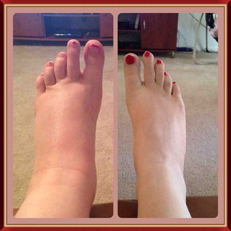 My severe edema - before and after! You will get your feet and ankles ...