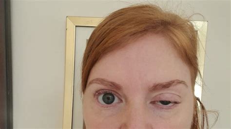 Botox 'left Northumberland woman unable to open eye for 16 weeks' - BBC News