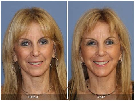 Facial Fat Grafting Los Angeles Before and After Photos