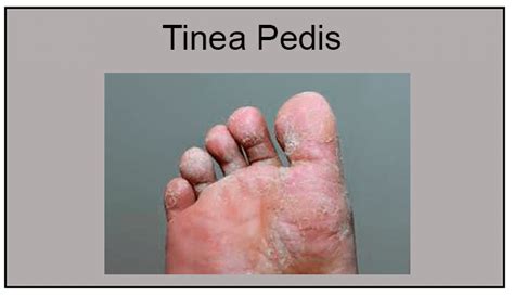 Tinea Pedis - Micose no Pé (Frieira) - Medicina de Excelência