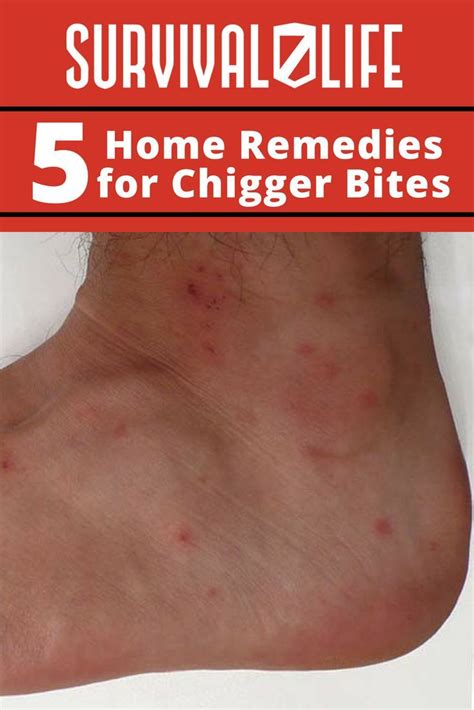 5 home remedies for chigger bites – Artofit