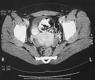 Abdominal CT Scan - Female