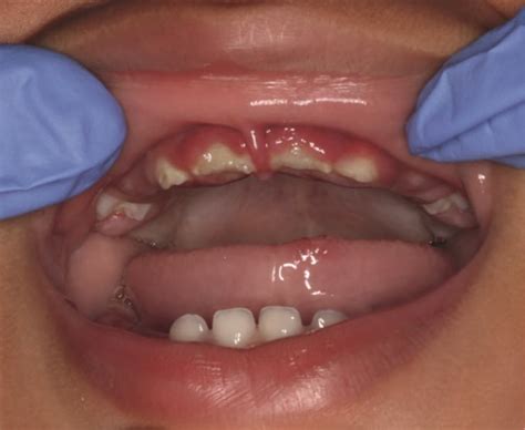 Primary herpetic gingivostomatitis in children | The BMJ