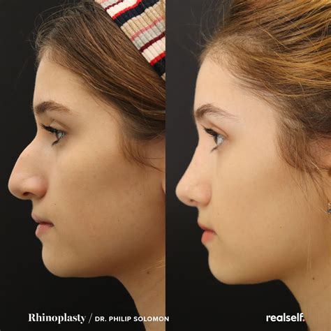 Collection 94+ Pictures Before And After Pictures Of Nose Jobs Stunning