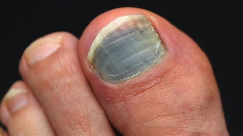 Black toenails: Causes and how to get rid of them - Starts at 60