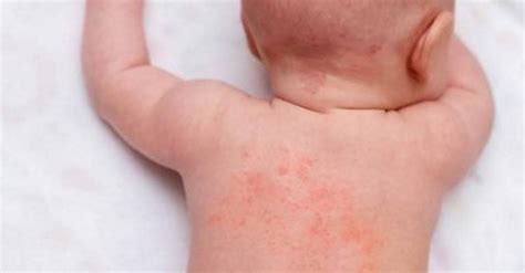 Heat Rash On Baby - Causes And Treatment | BellyBelly