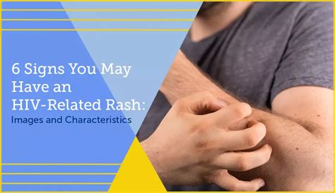 6 Signs You May Have an HIV-Related Rash: Images and Characteristics ...