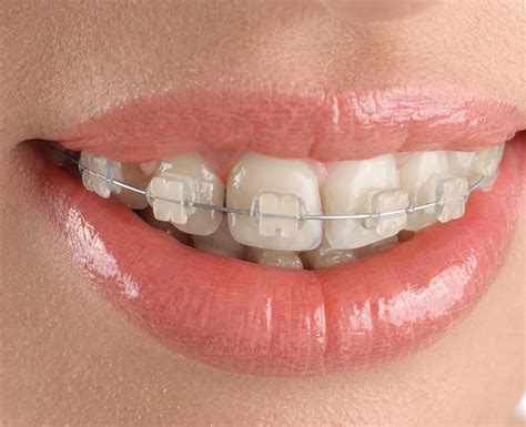 Clear Braces: Types, Benefits & How To Clean