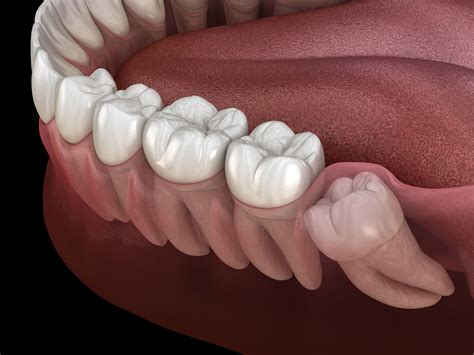 Sinus Headache After Wisdom Teeth Removal - Headache