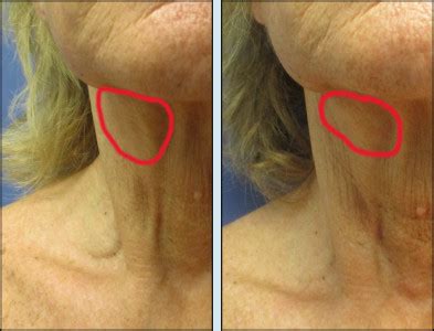 Lower Facelift and Neck Lift | Neck Lift Surgery Service | Chicago ...