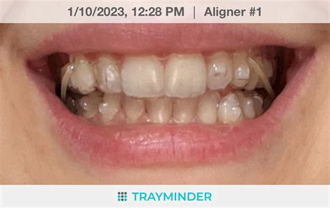 Day 1 - Surprise elastics, info in comments : r/Invisalign