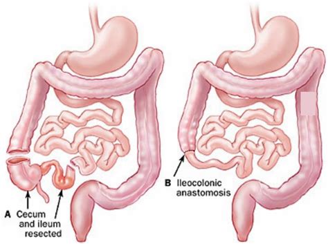 Anastomosis surgery, vascular anastomosis and bowel anastomosis