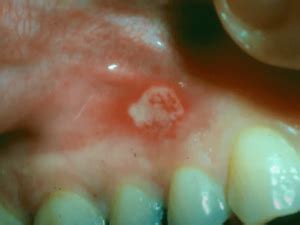 Aphthous Stomatitis: Treatment, Diagnosis, and Clinical Pictures