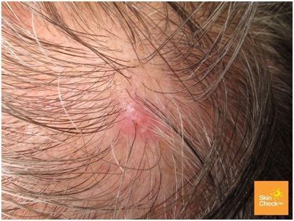 Skin Cancer on Scalp