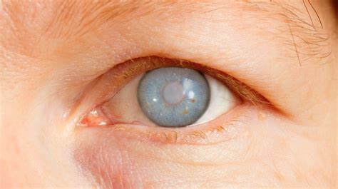 3 Herbal Glaucoma Natural Remedies | Healing The Eys