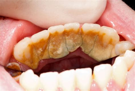 Plaque Teeth Meaning In English at Scotty Young blog