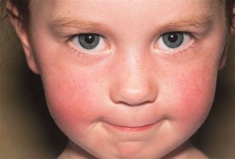 Childhood Skin Problems Slideshow: Images of Common Rashes and Skin Conditions in Children Rash ...