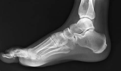 foot-xray - RCEMLearning