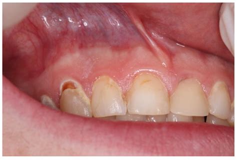 Dentistry Journal | Free Full-Text | The Correlation of Swedish Snus, Nicotine Pouches and Other ...