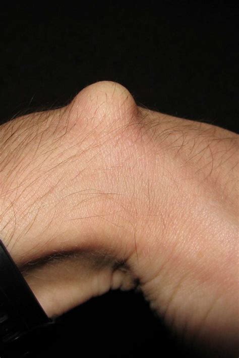 Ganglion cyst: Symptoms, causes, and treatment