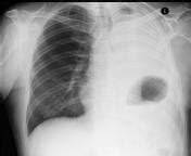 Pneumonectomy | Radiology Reference Article | Radiopaedia.org
