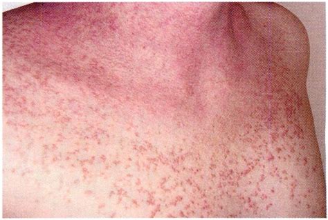 Heat Rash: All You Need to Know - Durofy - Business, Technology ...