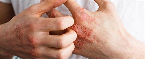 What Is Psoriatic Arthritis & How Do You Treat It? - Orthopedic & Sports Medicine