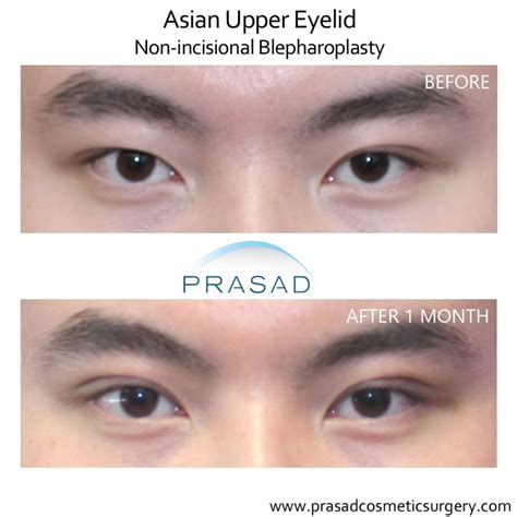 Uneven Eyes: When Treatment is Needed? | Dr. Prasad Blog