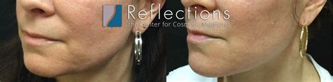 Voluma Filler for Jawline, Chin, Marionette Indentation Before & After Photos New Jersey ...