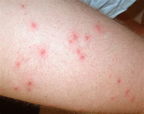 Pseudomonas Folliculitis : A Bacterial Folliculitis That Can Not Be ...