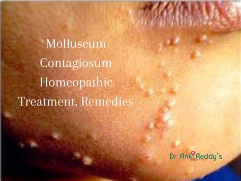 Molluscum Contagiosum Homeopathic Treatment, Remedies