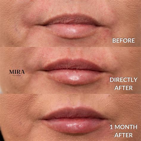 Lip Flip Or Lip Filler – Which Option Produces Better Results? - MIRA Clinic
