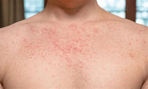 Les vitamines à prendre pour lutter contre un psoriasis