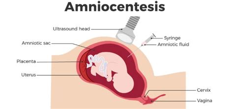 Amniocentesis Test in Pregnancy: Why Amniocentesis Is Performed, Risks ...