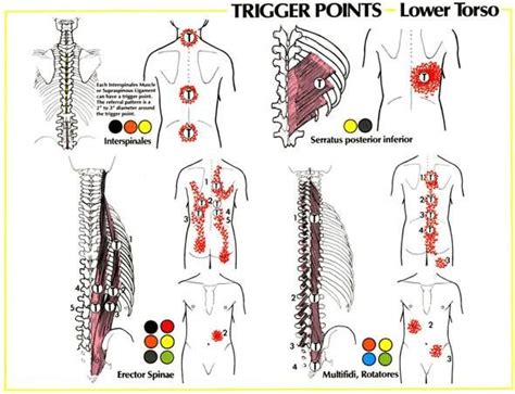 Treatments For The Back, Trigger Point Injections. | Info. Poster | Lower back pain exercises ...