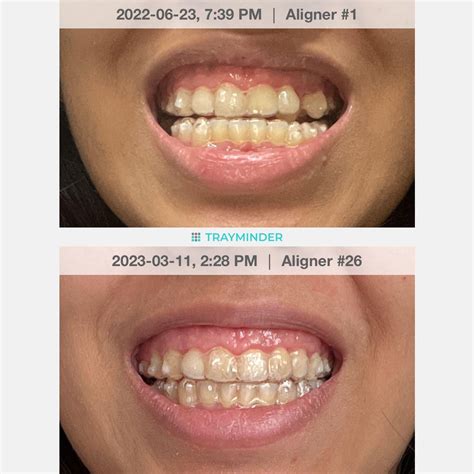 Final results! 🥳🥳🥳 : r/Invisalign