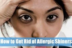 How to Get Rid of Allergic Shiners? Answer Here | Allergic Shiners